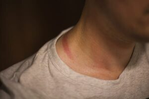 Verbrand door een camera strap